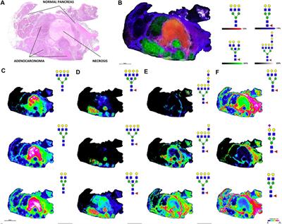 Recent Advances in Mass Spectrometry-Based Glycomic and Glycoproteomic Studies of Pancreatic Diseases